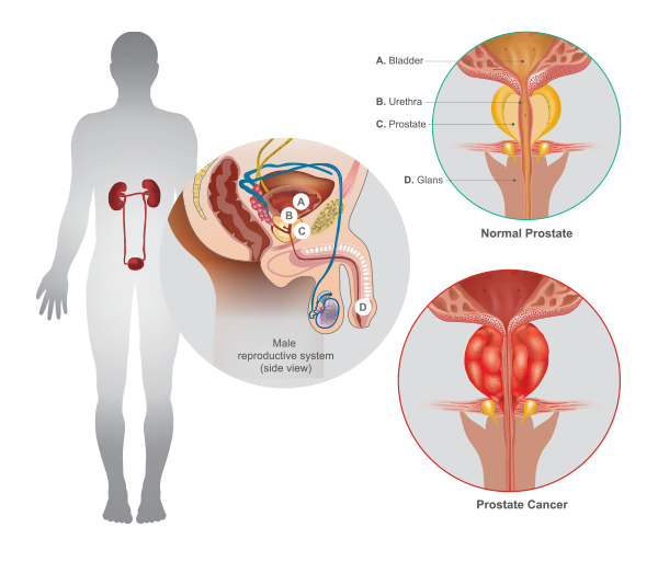conditions treated, prostate cancer, treatment for prostate cancer