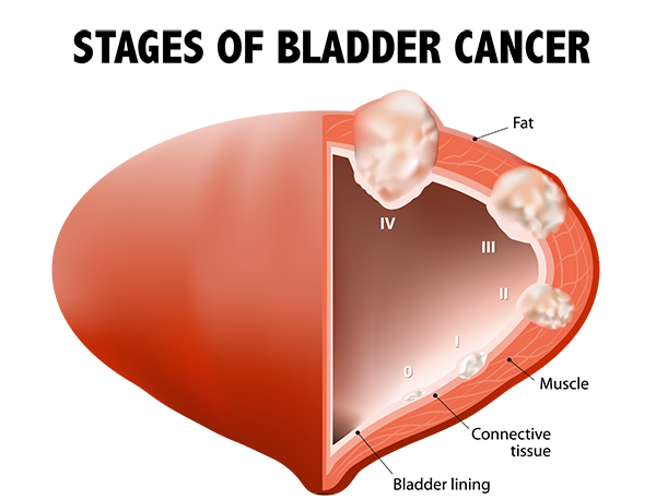 conditions treated, treatment for bladder cancer, bladder cancer