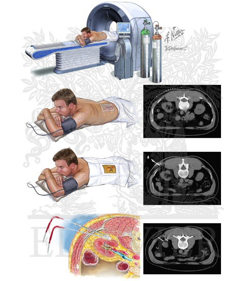 Percutaneous Cryoblation