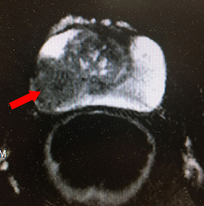 prostate cancer